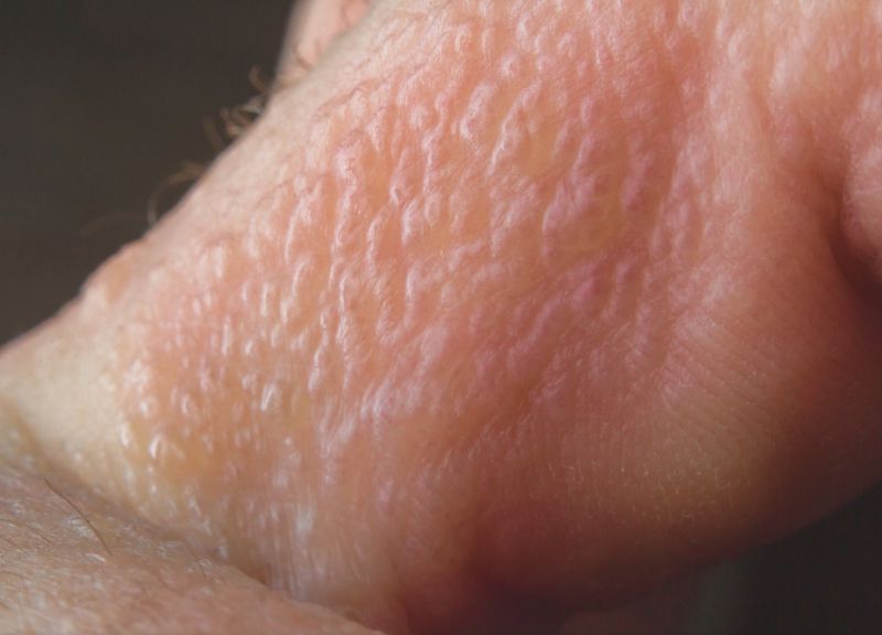 You may need to see a dermatologist if the rash is severe.